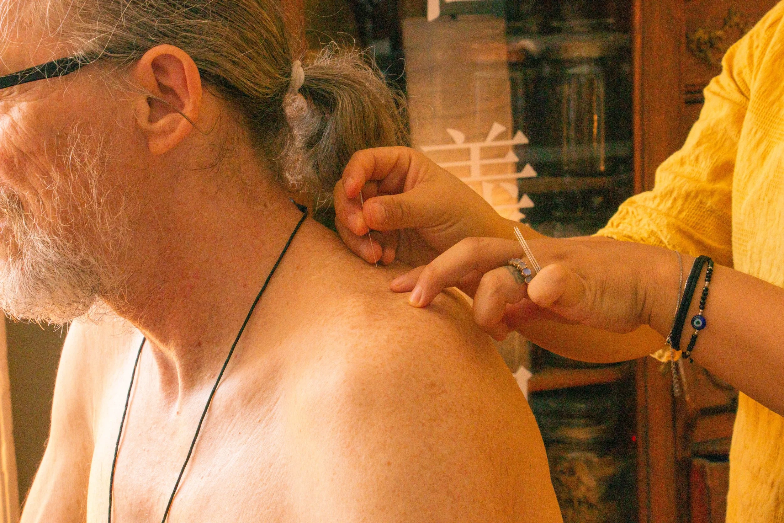 Follow-Up Acupuncture Treatments
