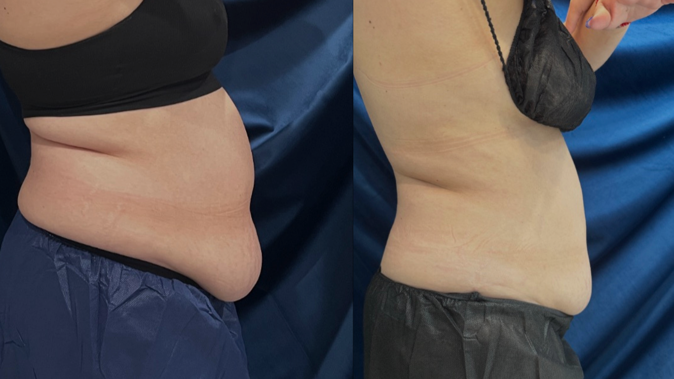 CoolSculpting before and after at Beauty and the Med Spa