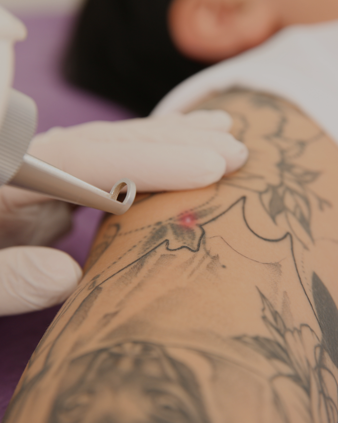 Easy tattoo Removal at Beauty and the Med Spa.