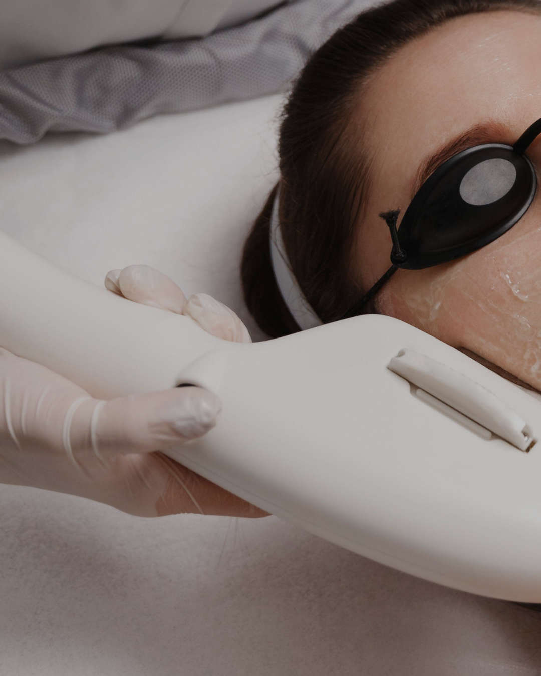IPL photo facial in St.John, Indiana.