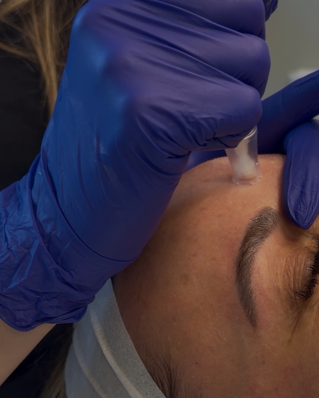 Microneedling at Beauty and the Med Spa.