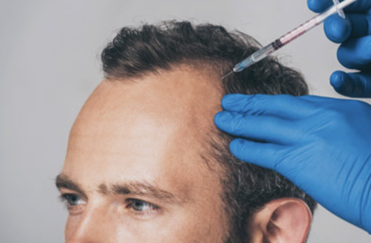A person receiving a hair injection or medical treatment on the scalp, with a healthcare worker wearing blue gloves administering the injection.