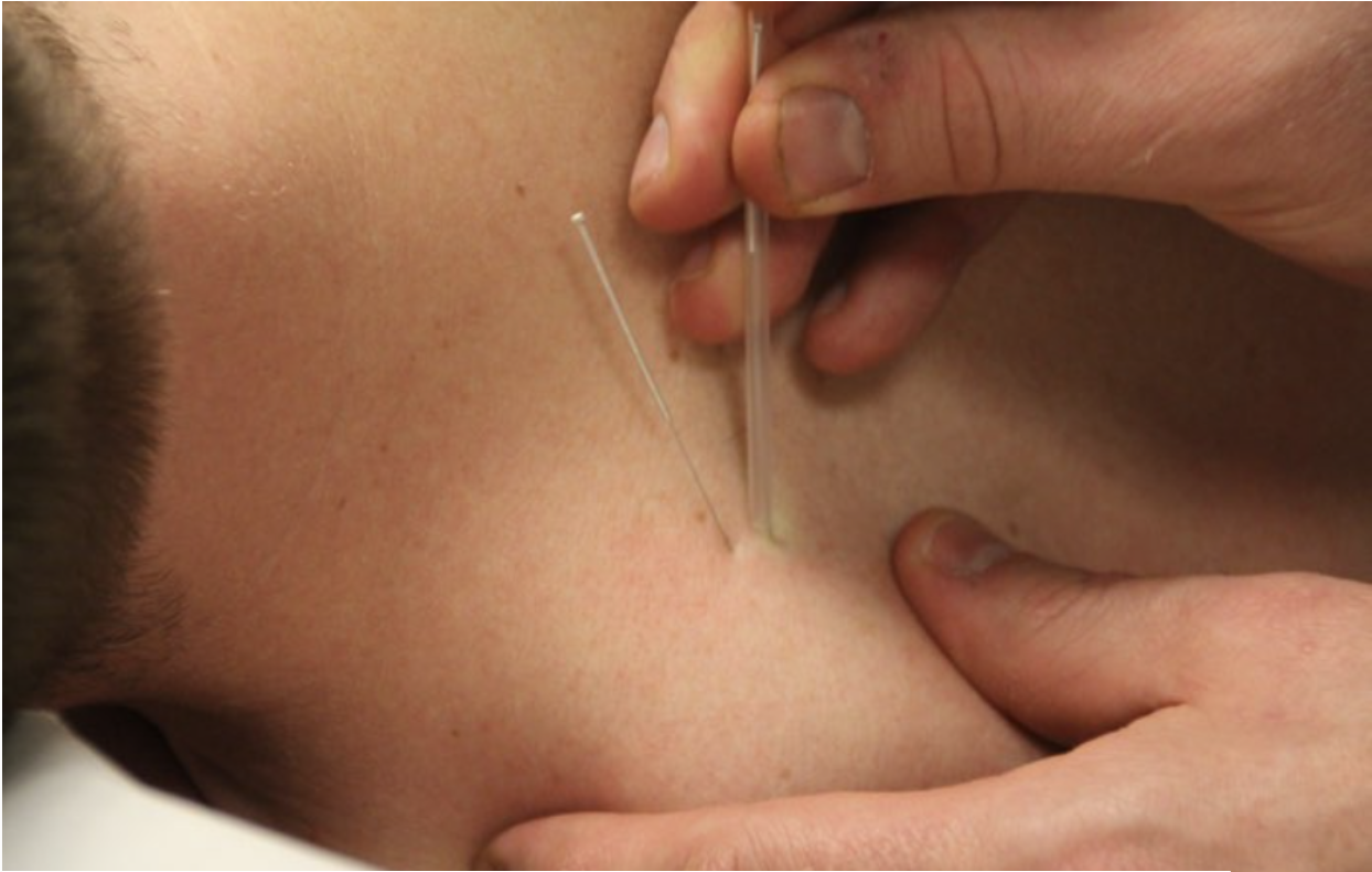 Nålebehandling (IMS)