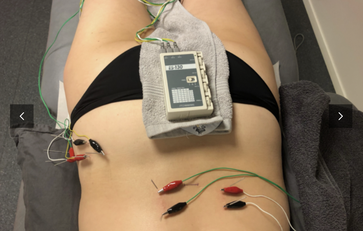 Funksjonell Perifer Nerve­stimulering