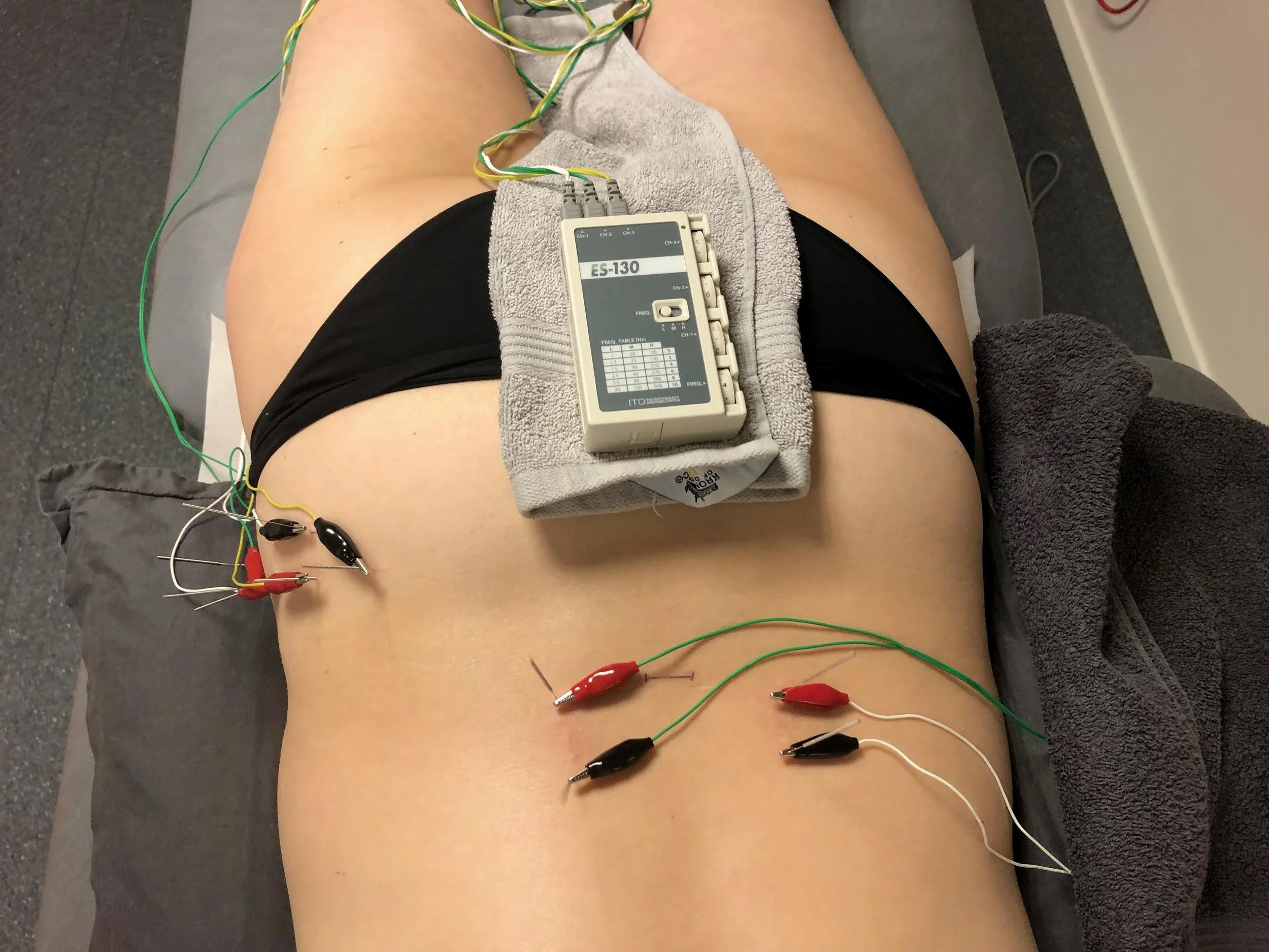 Funksjonell Perifer Nerve­stimulering