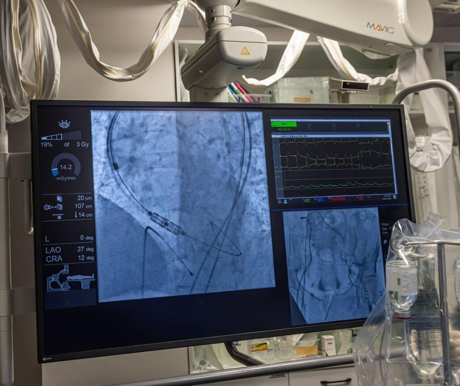 angiography monitor showing minimally invasive vascular procedure used to diagnose and treat blocked arteries