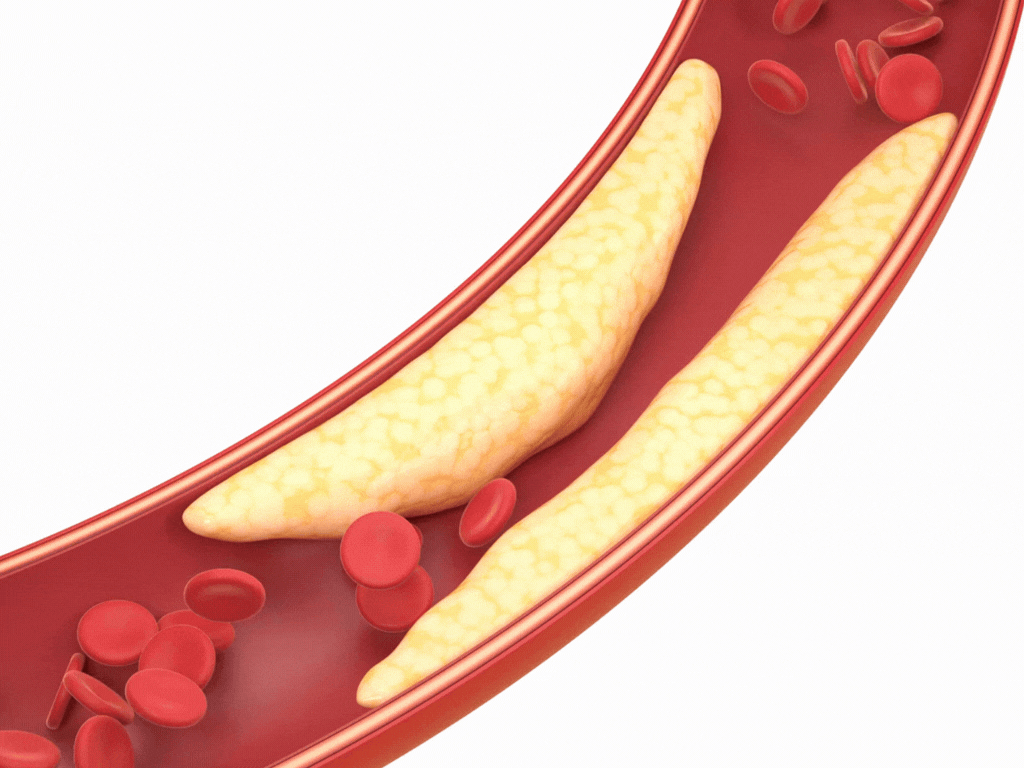 llustration of fatty plaque buildup inside artery that can contribute to blood clot formation