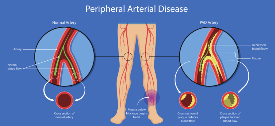 medical diagram showing peripheral artery disease with plaque buildup reducing blood flow in leg arteries