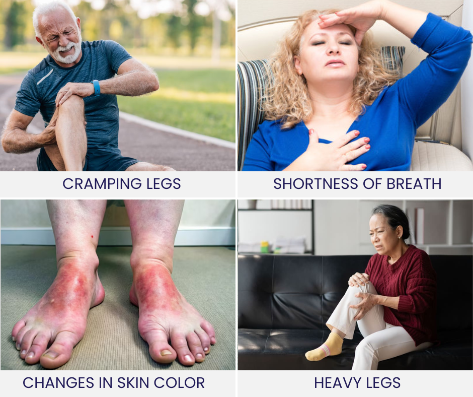 illustration showing symptoms of vascular disease including leg cramping, shortness of breath, skin color changes, and heavy legs
