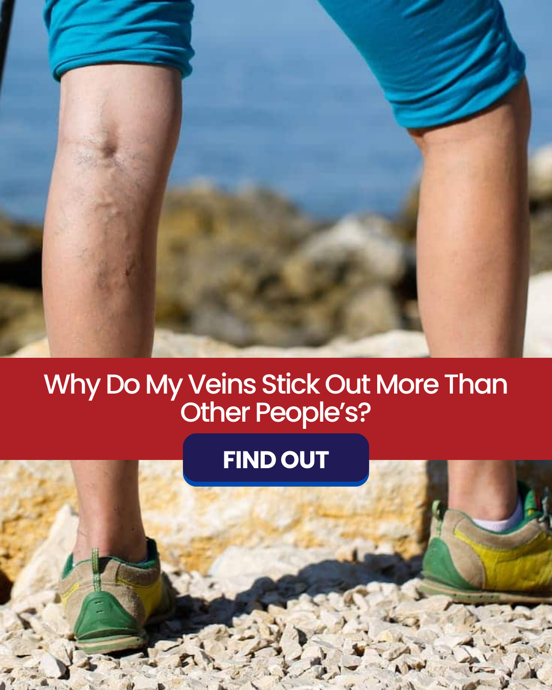 Why Do My Veins Stick Out More Than Other People’s?