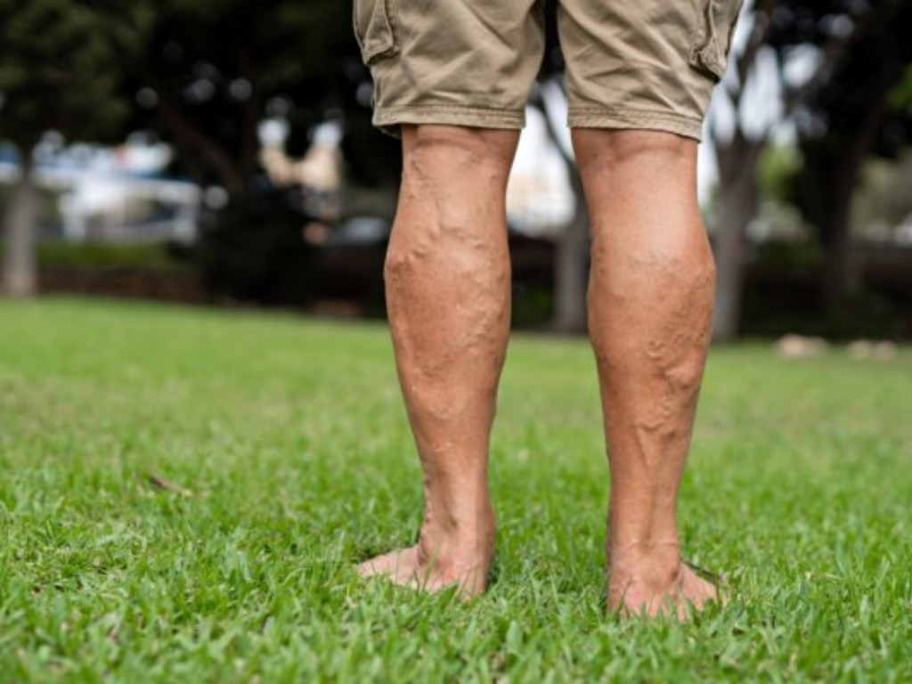 bulging varicose veins on calf showing signs of venous insufficiency in the legs