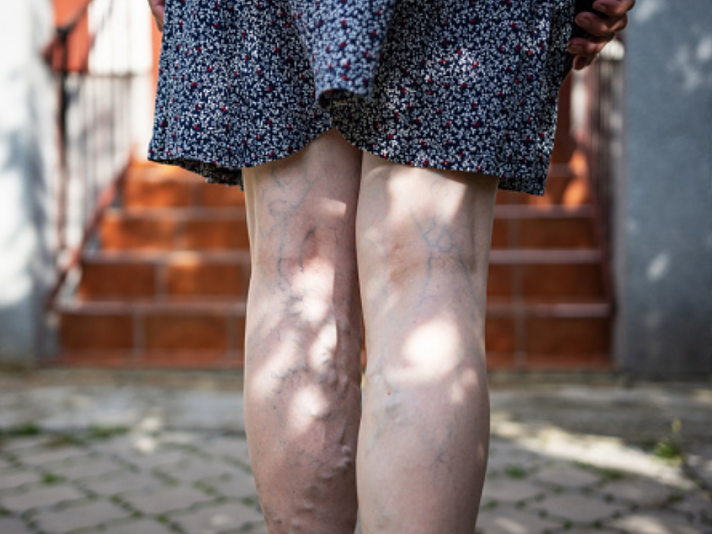 visible veins on legs illustrating early varicose veins and possible venous circulation problems