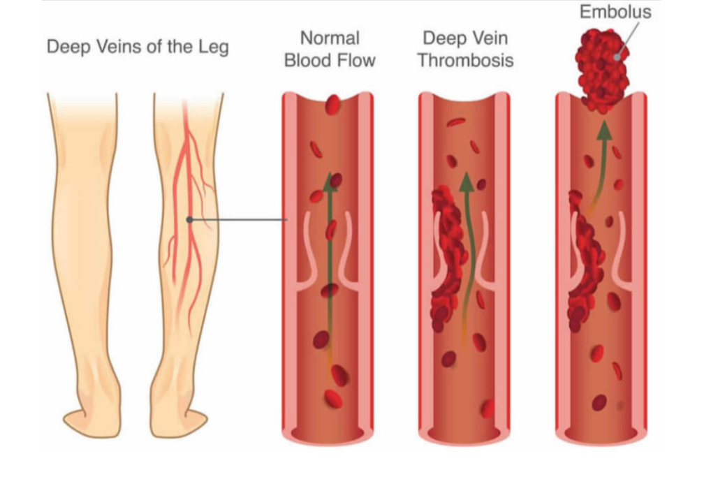 diagram showing deep vein thrombosis in the leg and how clots can travel through the bloodstream