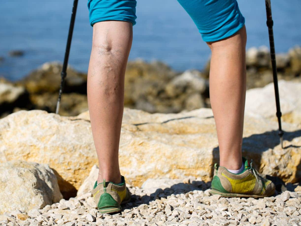 person walking on rocky trail with visible leg veins representing circulation problems and peripheral artery disease symptoms