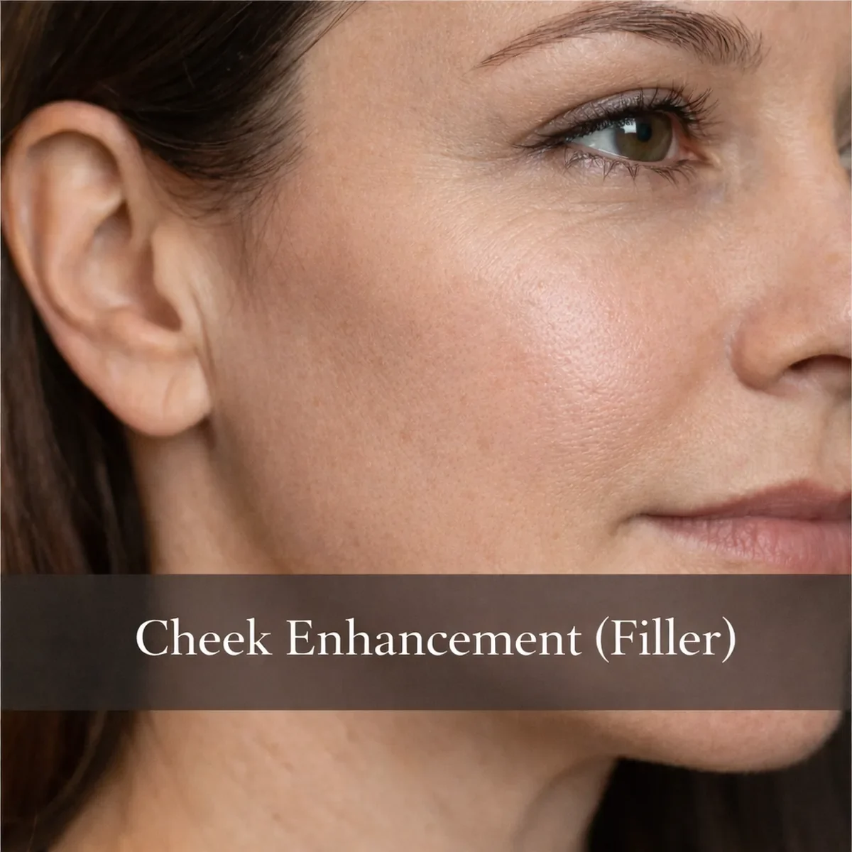 Cheek Enhancement (Filler)