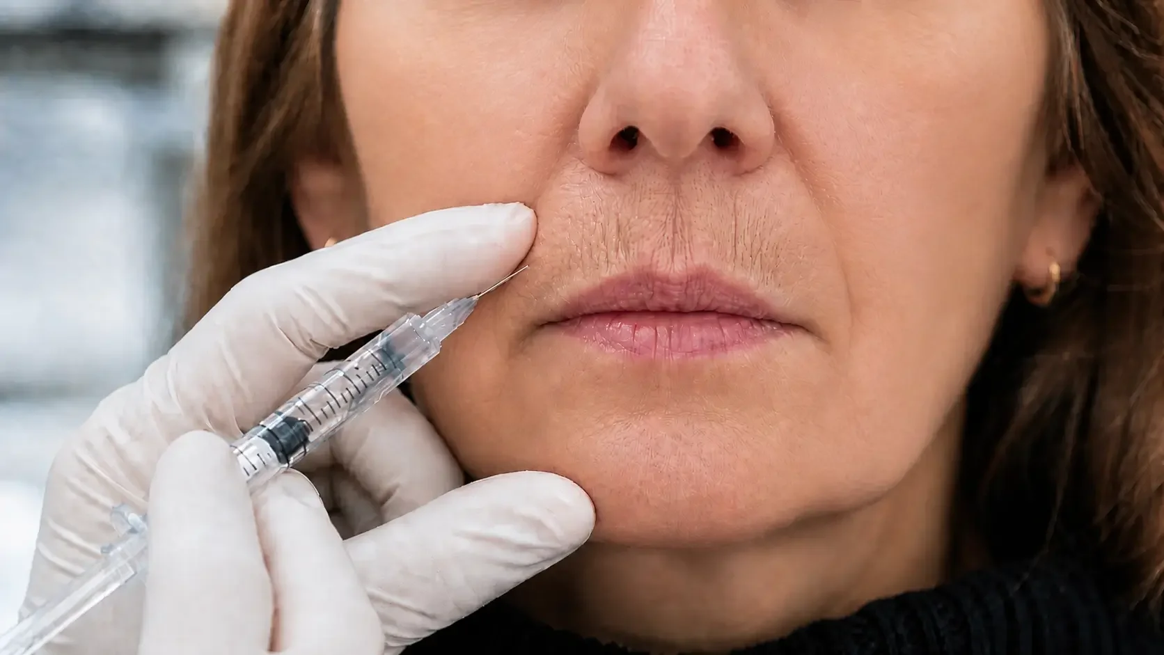 Physician-performed Botox for perioral lines and smoker’s lines at NeuroBeauty Clinic in Walnut Creek