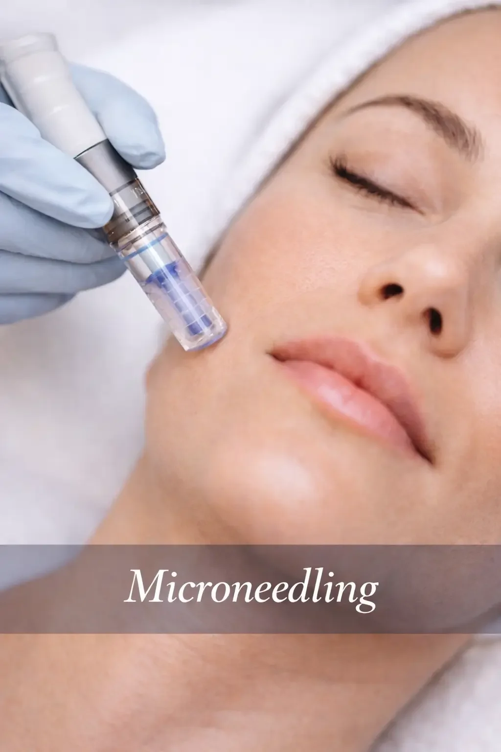SkinPen Microneedling – Face and Neck (3-Session Package)