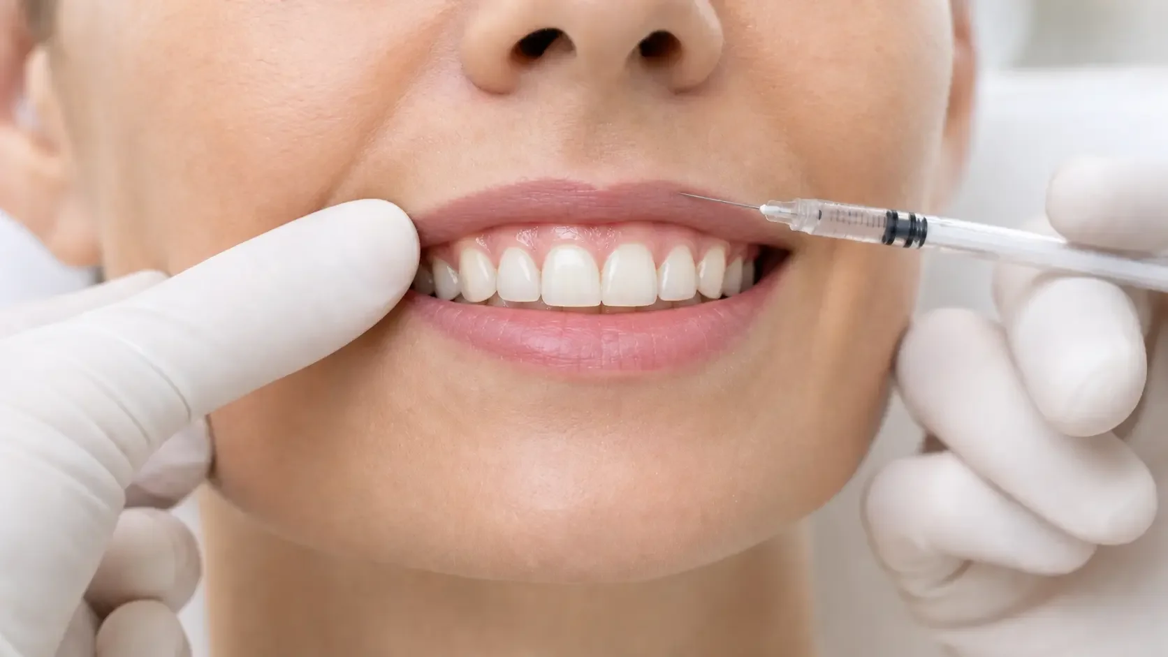 Botox for a Gummy Smile at NeuroBeauty