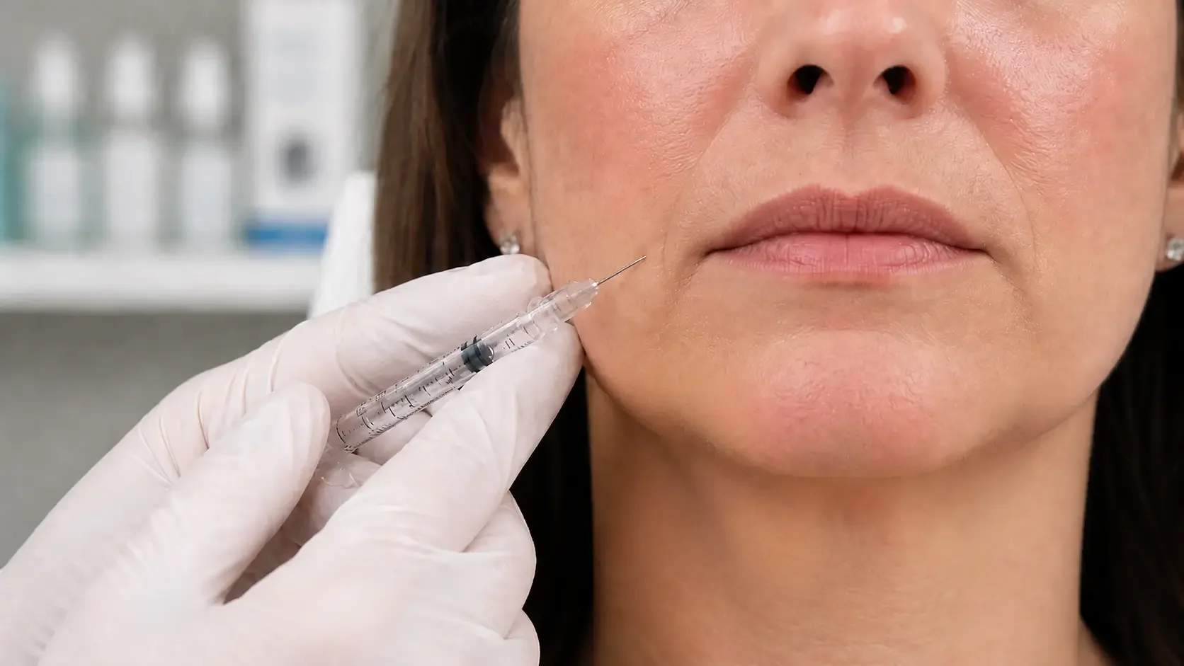 Physician-performed Botox for marionette lines and downturned mouth at NeuroBeauty Clinic in Walnut Creek
