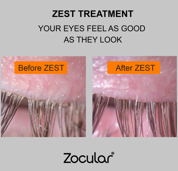 Zest Eye Treatment Gainsborough