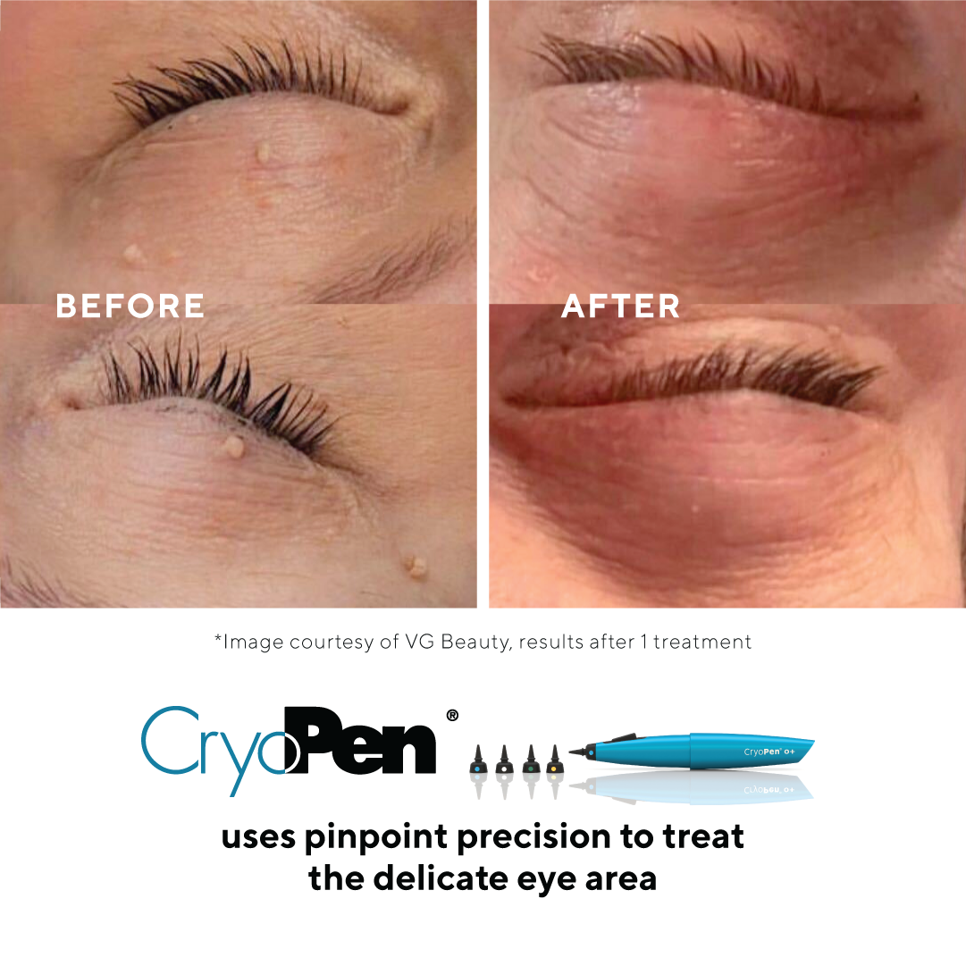 Eyelid skin tag leison removal