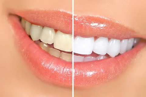 LASER TEETH WHITENING