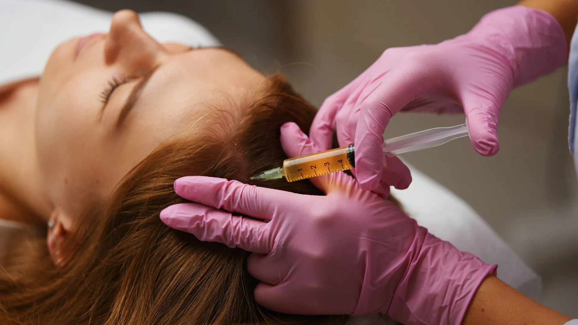 Platelet Rich Plasma Mesotherapy Injection for Hair