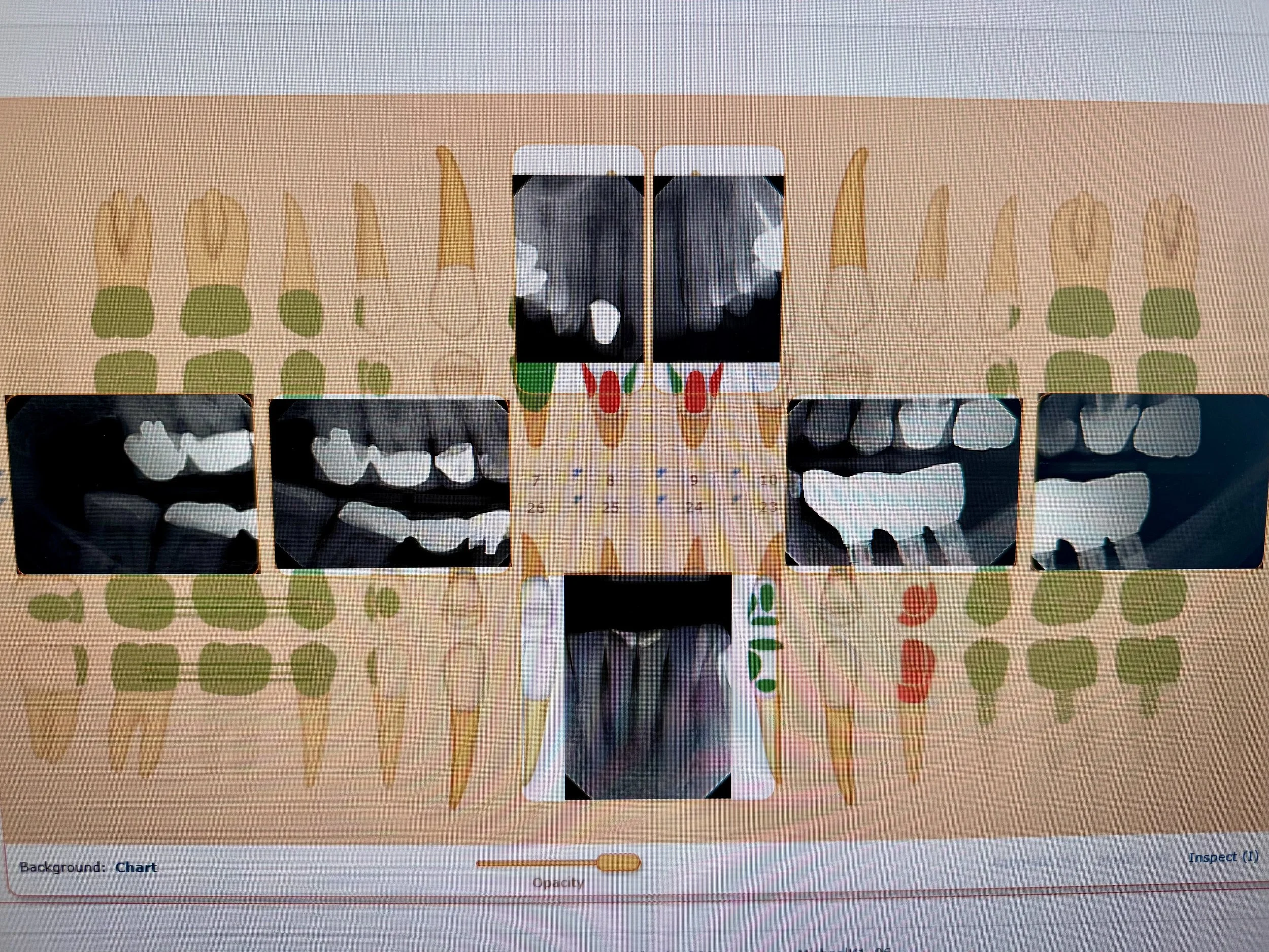 Digital dental chart with X-ray images of teeth and gums, showing various views of dental structures and dental work.