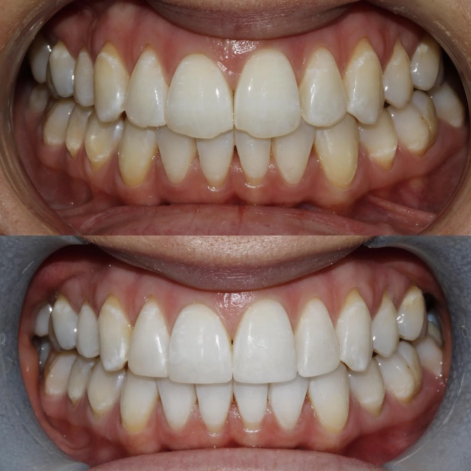 Comparison of teeth before and after dental treatment, demonstrating the use of composite bonding to reshape uneven teeth, using a natural tone for the teeth.