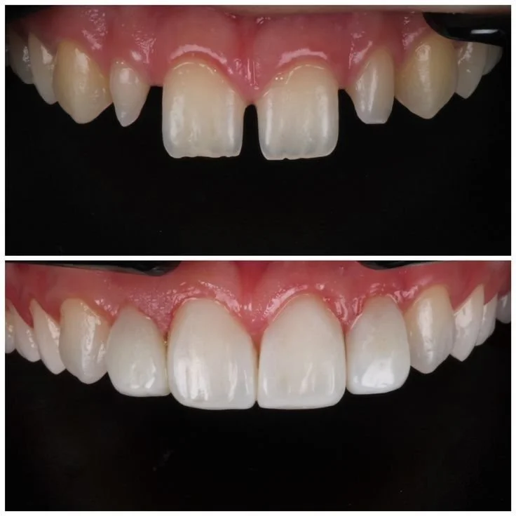 Before and after images showing dental restoration with veneers, improving the appearance of cracked and chipped front teeth.