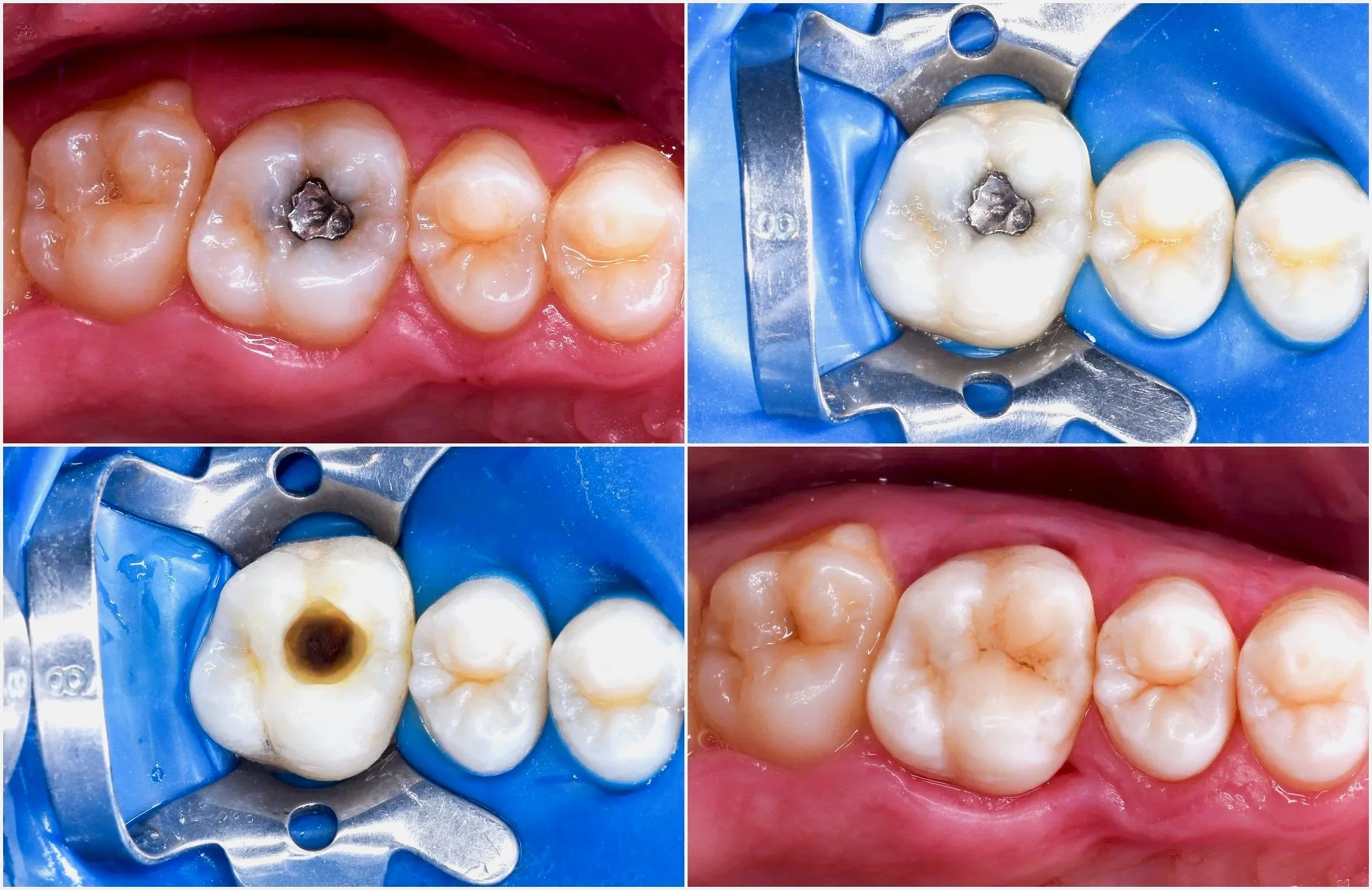 Close-up of a person's upper front teeth with measurement markings indicating the golden ratio, an aesthetic guide for cosmetic dentistry.