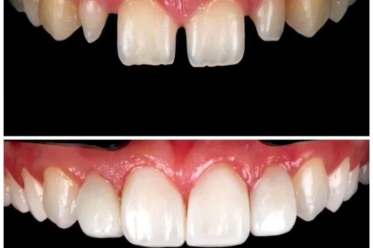 Before and after images showing dental restoration with veneers, improving the appearance of cracked and chipped front teeth.