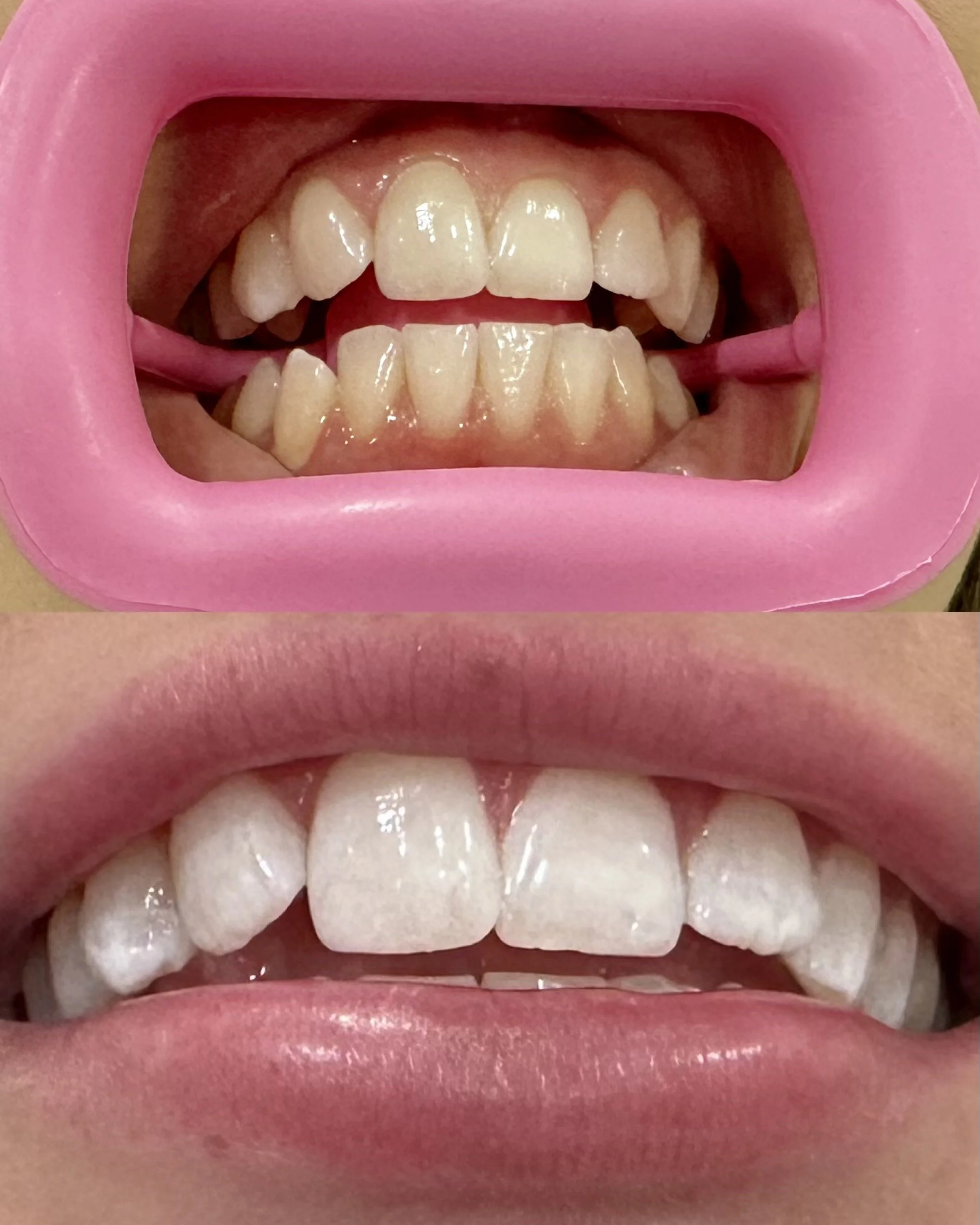 Close-up of a child's teeth before and after dental whitening, showing the improvement in tooth whiteness.
