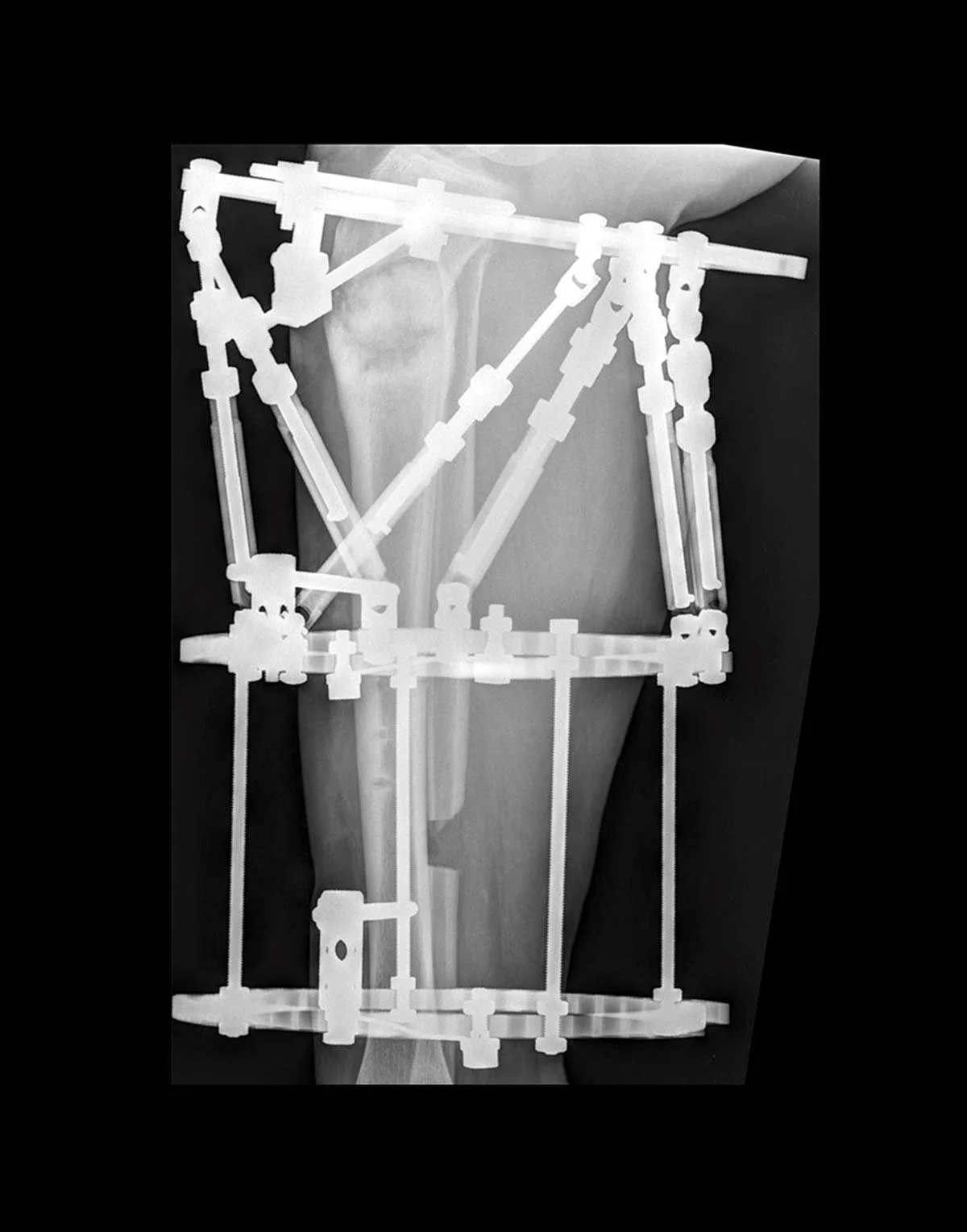 X-ray of a knee with an external metal frame used for medical support.