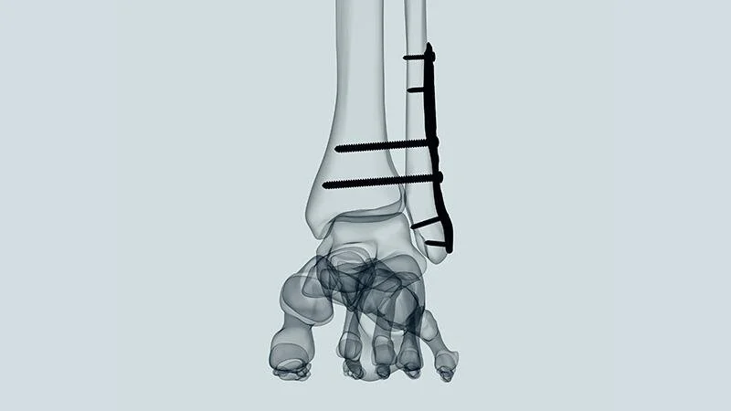 An X-ray image of a human foot with screws and hardware in the bones, indicating surgical repair.