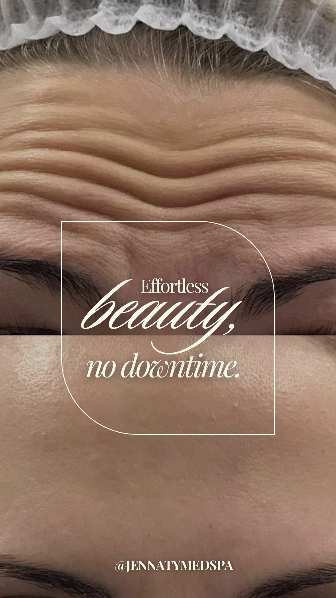 botox before and after.png