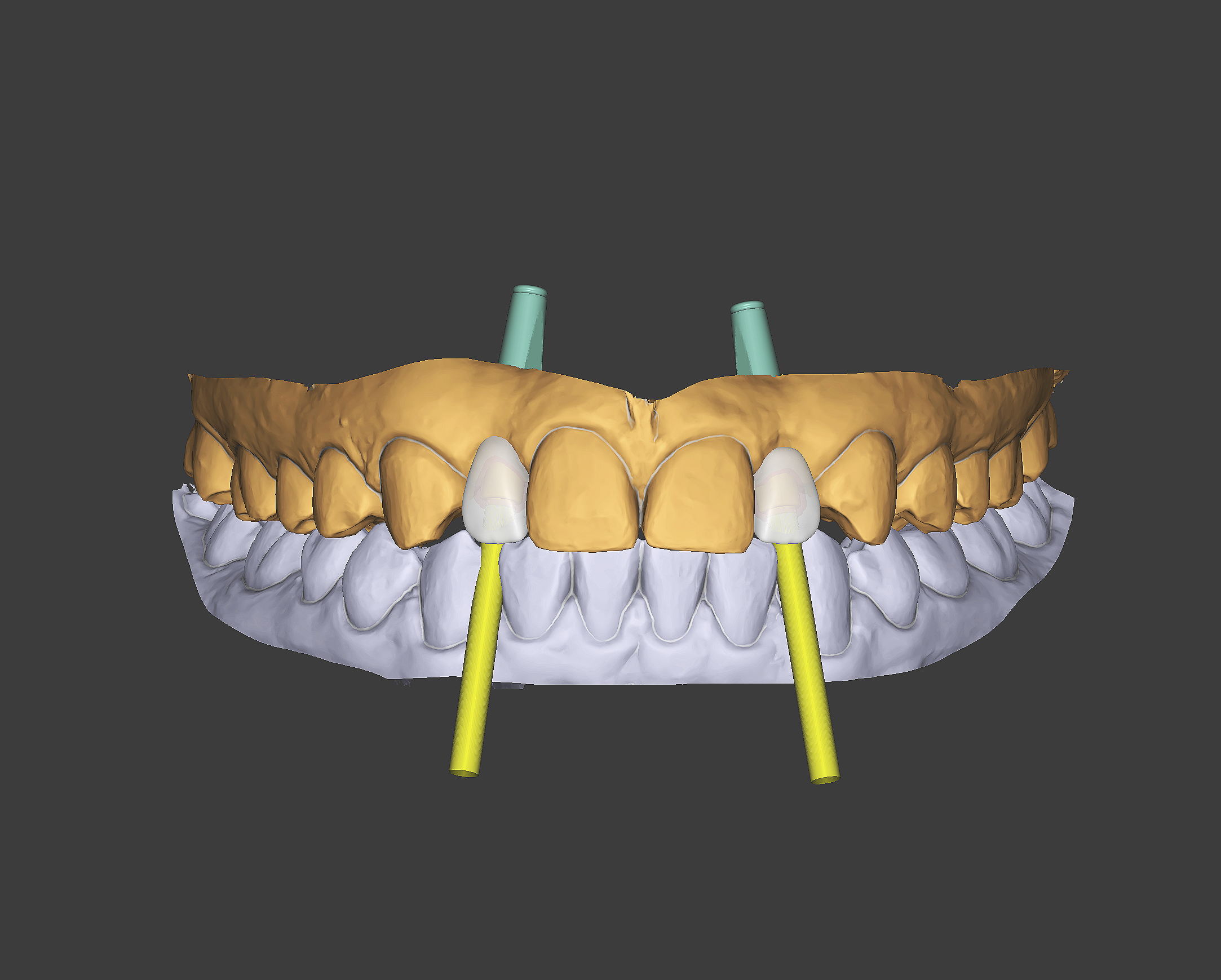 Implant Supported Crowns & Bridges