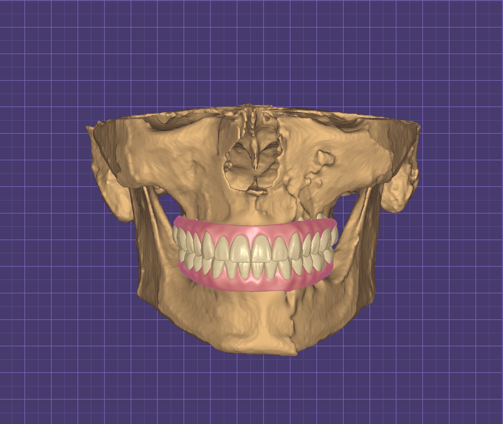 AOX Full Arch Design