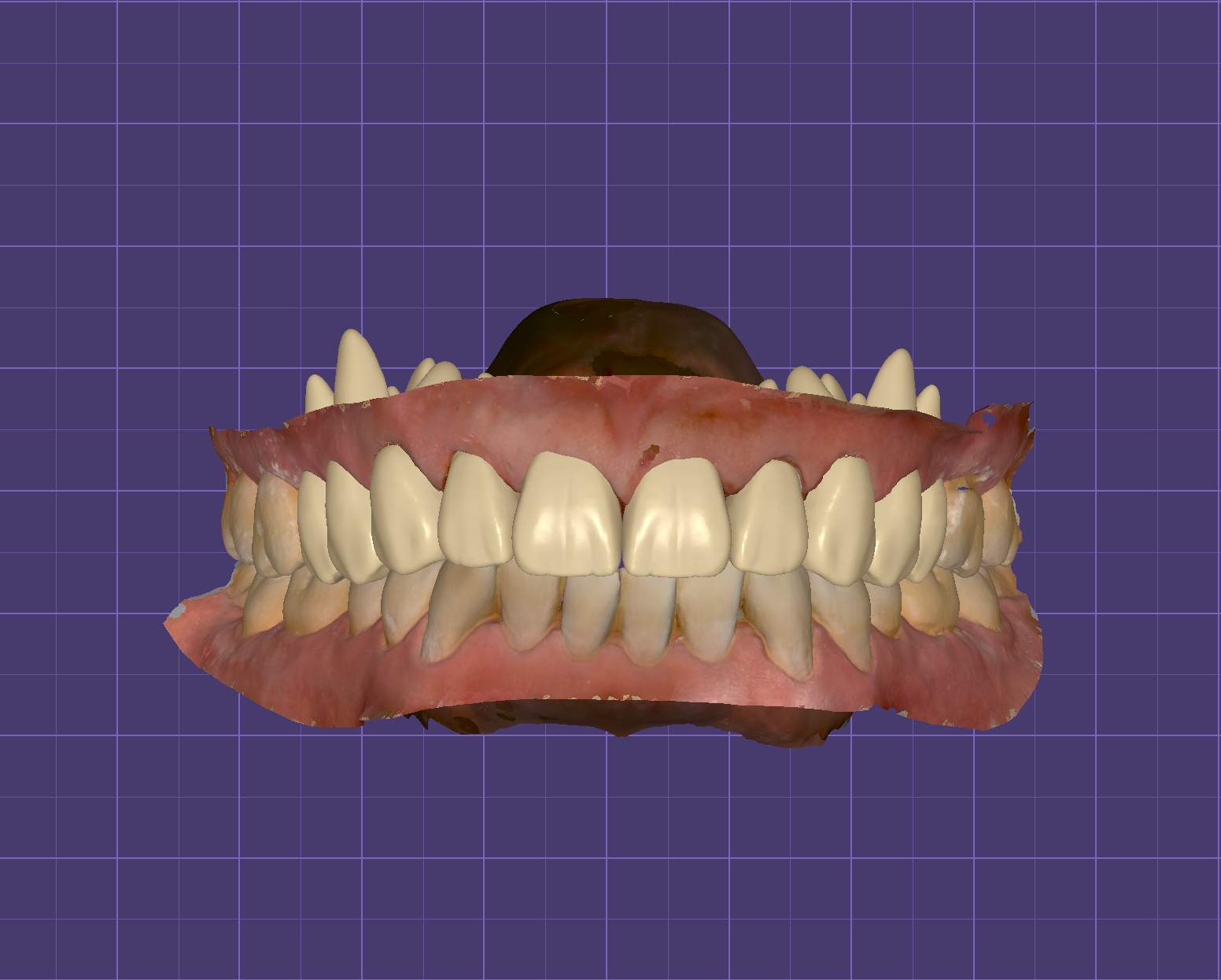 Full Mouth Rehabilitation & Smile Design