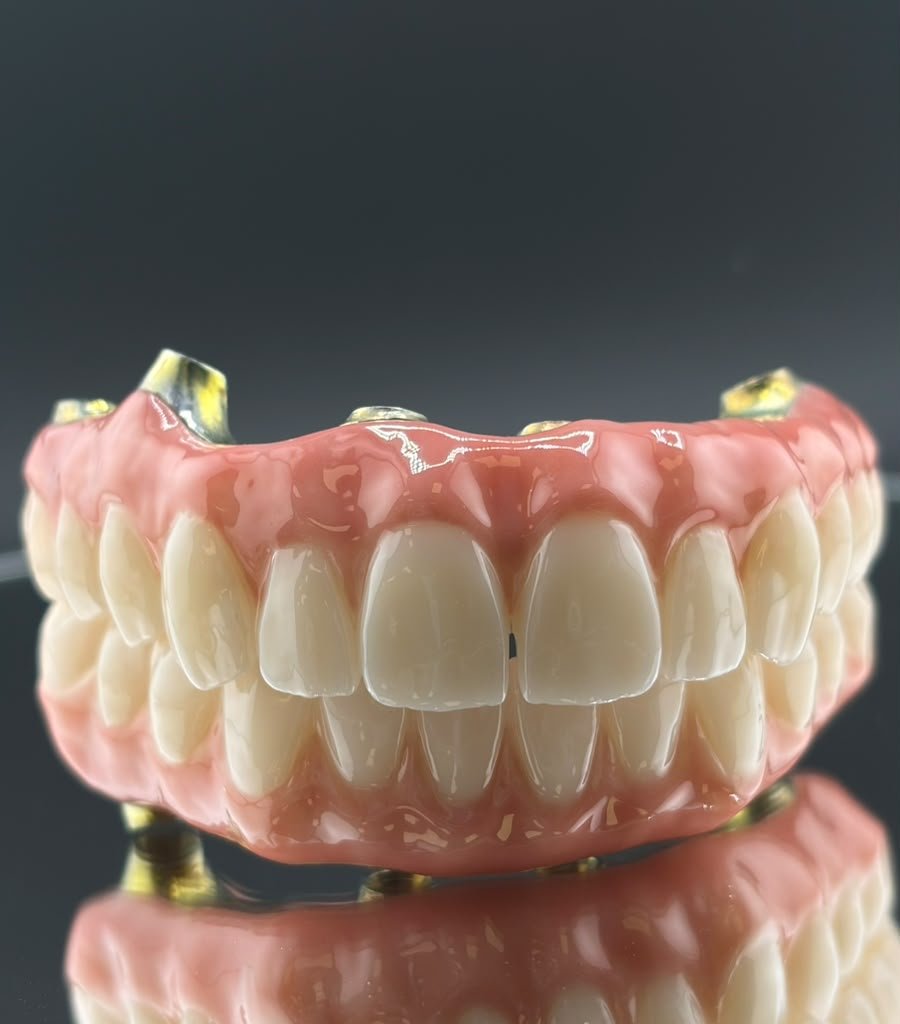 Full Mouth Rehabilitation & Smile Design