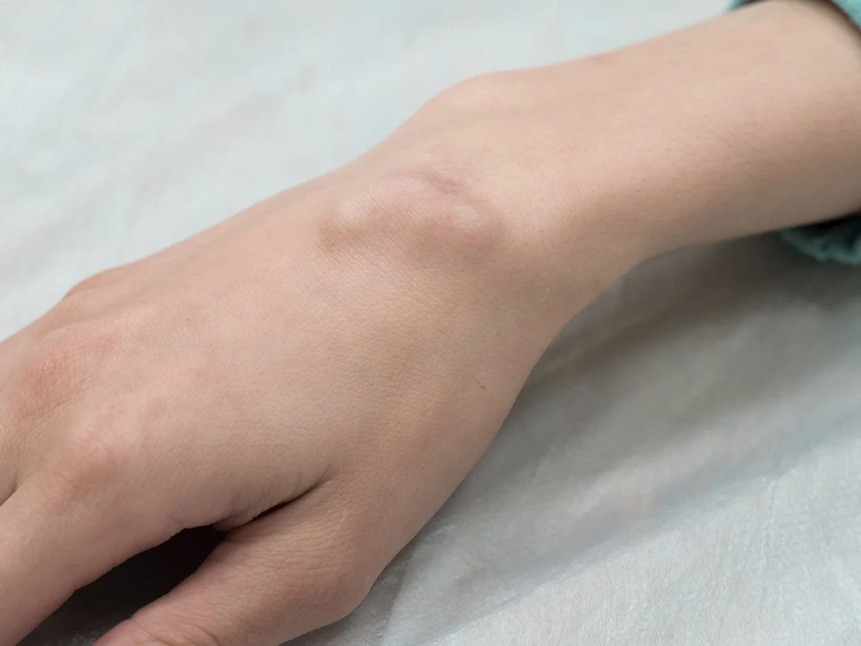 Dr Patrick Lau Canberra General Surgery Skin Surgery