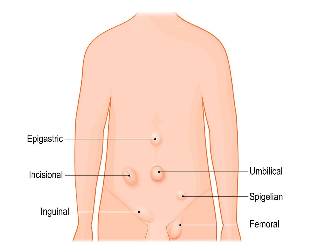 Dr Patrick Lau Canberra General Surgery Hernia Surgery