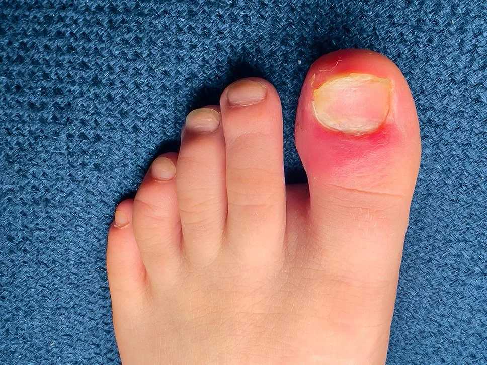 Ingrown Toenail surgery Canberra Dr Patrick Lau