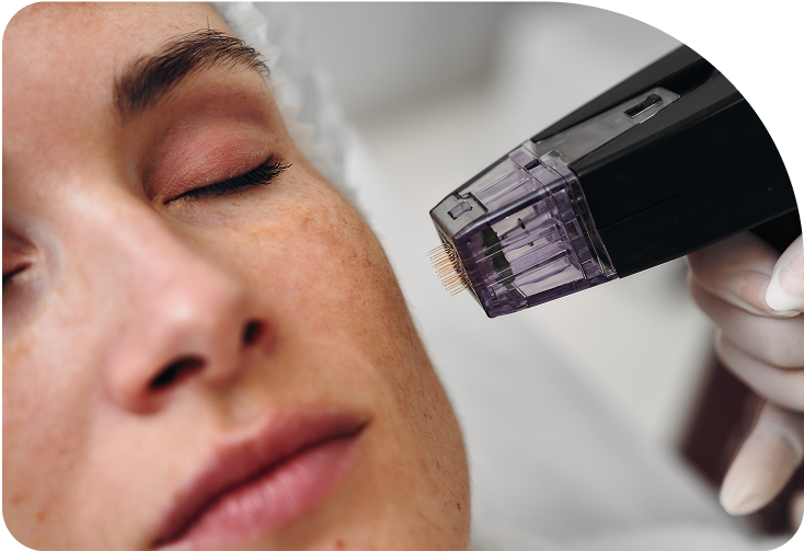 Everything RF Microneedling Can Treat