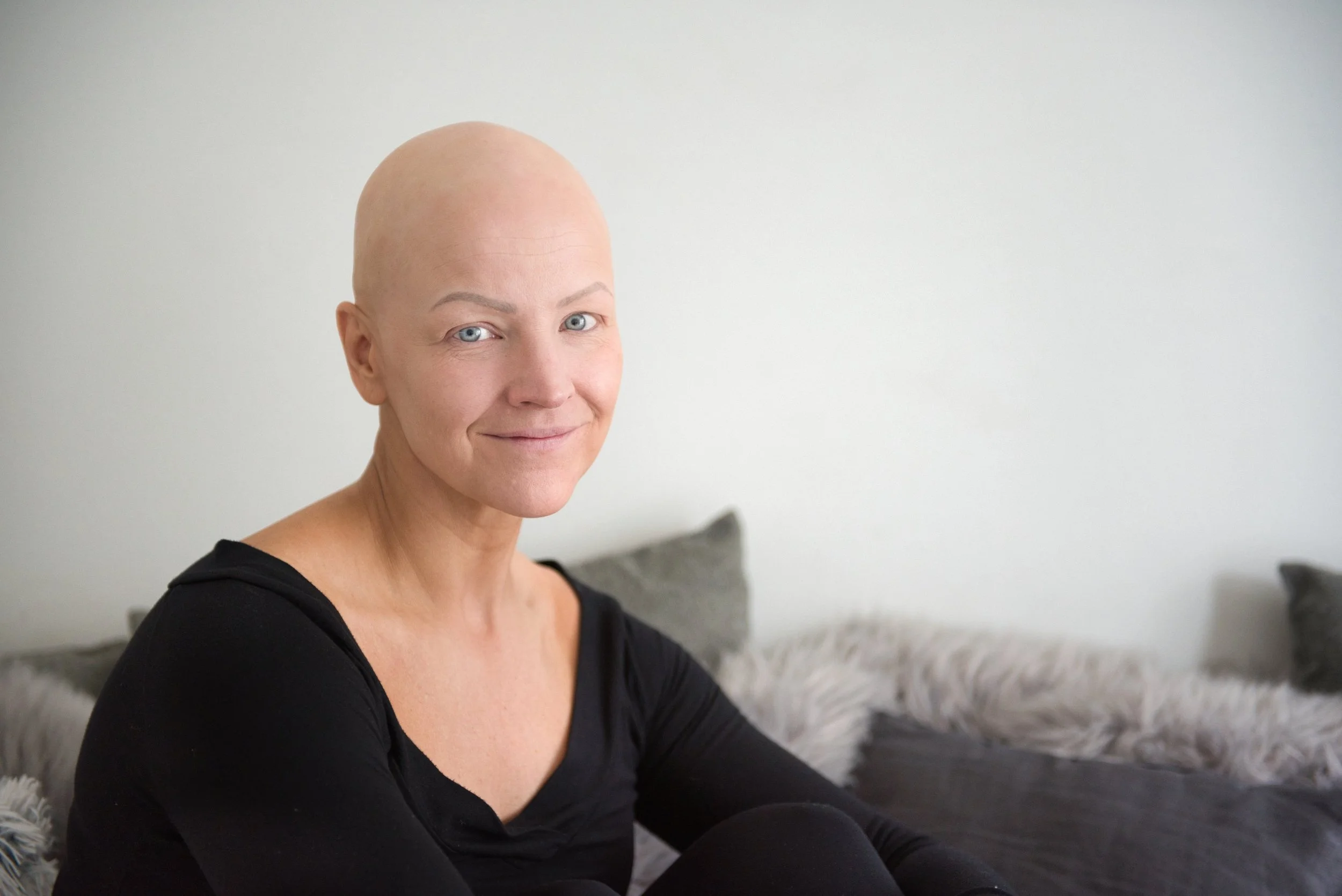Alopecia