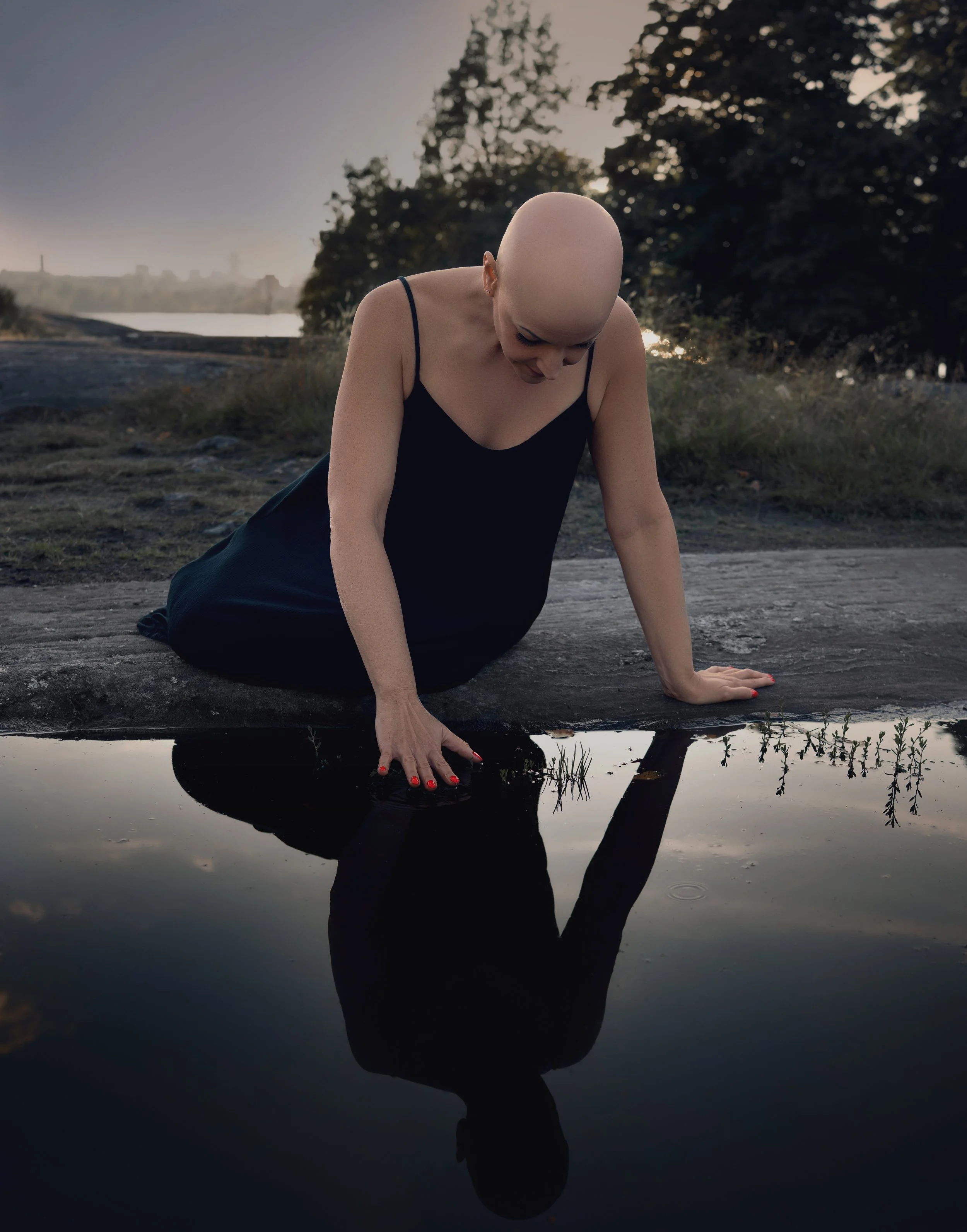 Alopecia Areata hair loss