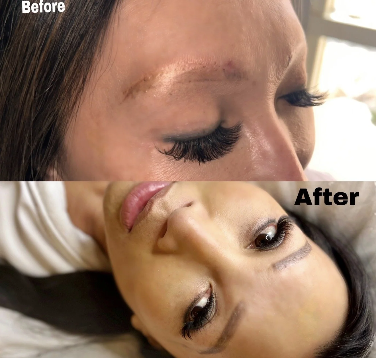 Scar camouflage tattooing (coming soon)