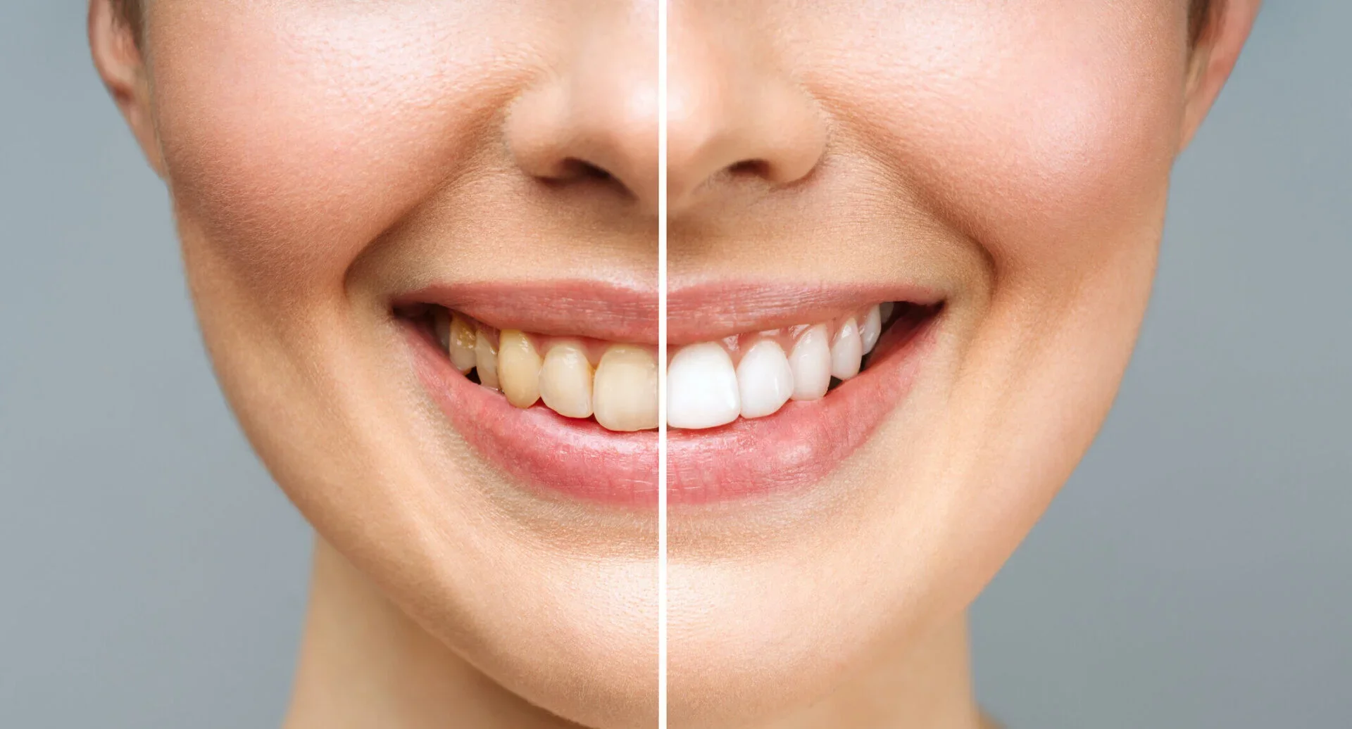 Imagen dividida en dos partes mostrando un lado con dientes amarillos y otro con dientes blancos y brillantes.