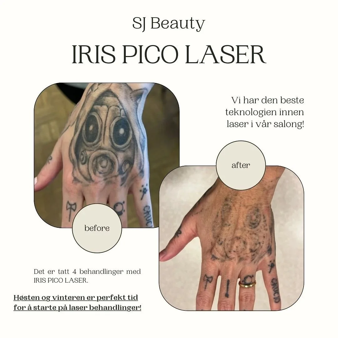 Pico Laser Fredrikstad