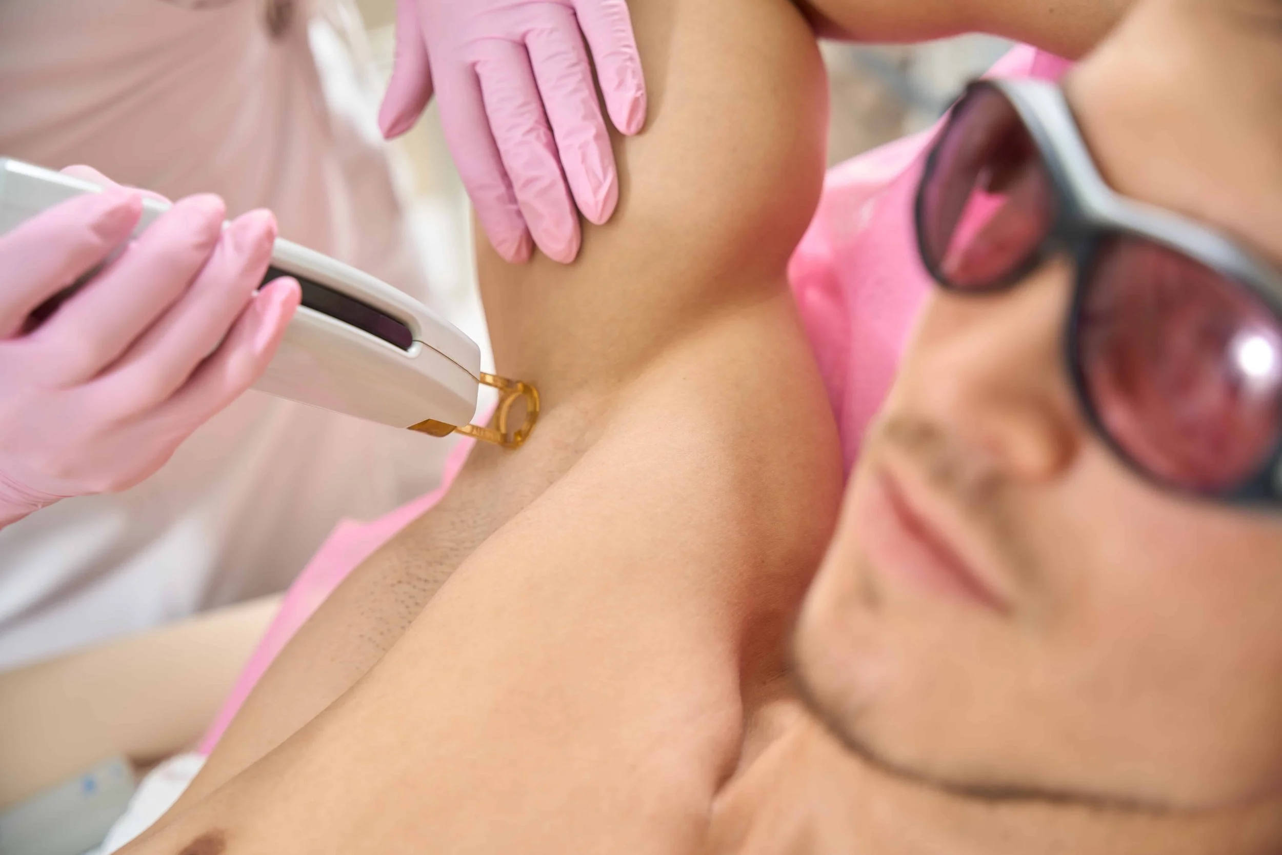 Person som får hårfjerning med laser på bikinilinjen av en kosmetolog, begge bruker beskyttelsesbriller.